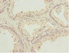 Immunohistochemistry of paraffin-embedded human prostate cancer using CSB-PA012488ESR1HU at dilution of 1:100