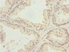 Immunohistochemistry of paraffin-embedded human prostate cancer using CSB-PA012488ESR2HU at dilution of 1:100