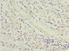 Immunohistochemistry of paraffin-embedded human gastric cancer using CSB-PA013695ESR1HU at dilution of 1:100