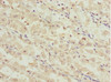 Immunohistochemistry of paraffin-embedded human gastric cancer using CSB-PA013695ESR2HU at dilution of 1:100