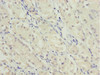 Immunohistochemistry of paraffin-embedded human gastric cancer using CSB-PA873627ESR1HU at dilution of 1:100