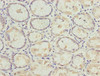 Immunohistochemistry of paraffin-embedded human gastric cancer using CSB-PA873627ESR2HU at dilution of 1:100