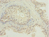 Immunohistochemistry of paraffin-embedded human prostate cancer using CSB-PA622775ESR2HU at dilution of 1:100