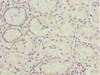 Immunohistochemistry of paraffin-embedded human gastric cancer using CSB-PA889125ESR2HU at dilution of 1:100