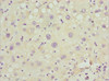 Immunohistochemistry of paraffin-embedded human liver cancer using CSB-PA017800ESR1HU at dilution of 1:100