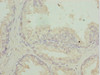 Immunohistochemistry of paraffin-embedded human prostate cancer using CSB-PA019599ESR1HU at dilution of 1:100