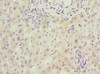 Immunohistochemistry of paraffin-embedded human liver cancer using CSB-PA020755DSR1HU at dilution of 1:100