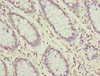 Immunohistochemistry of paraffin-embedded human colon cancer using CSB-PA859949ESR2HU at dilution of 1:100