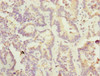Immunohistochemistry of paraffin-embedded human lung cancer using CSB-PA897531ESR1HU at dilution of 1:100