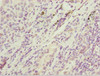 Immunohistochemistry of paraffin-embedded human lung cancer using CSB-PA897531ESR2HU at dilution of 1:100