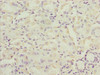 Immunohistochemistry of paraffin-embedded human gastric cancer using CSB-PA891565ESR2HU at dilution of 1:100