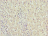 Immunohistochemistry of paraffin-embedded human liver cancer using CSB-PA027041ESR2HU at dilution of 1:100