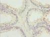 Immunohistochemistry of paraffin-embedded human prostate cancer using CSB-PA023626ESR1HU at dilution of 1:100