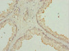 Immunohistochemistry of paraffin-embedded human prostate cancer using CSB-PA750879ESR1HU at dilution of 1:100