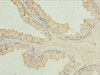 Immunohistochemistry of paraffin-embedded human prostate cancer using CSB-PA750879ESR2HU at dilution of 1:100