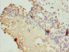 Immunohistochemistry of paraffin-embedded human breast cancer using CSB-PA867198ESR2HU at dilution of 1:100