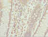 Immunohistochemistry of paraffin-embedded human colon cancer using CSB-PA867174DSR1HU at dilution of 1:100