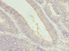 Immunohistochemistry of paraffin-embedded human endometrial cancer using CSB-PA867174DSR2HU at dilution of 1:100