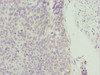 Immunohistochemistry of paraffin-embedded human cervical cancer using CSB-PA026565ESR1HU at dilution of 1:100