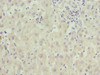 Immunohistochemistry of paraffin-embedded human liver cancer using CSB-PA026826ESR2HU at dilution of 1:100