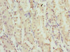 Immunohistochemistry of paraffin-embedded human gastric cancer using CSB-PA026830ESR2HU at dilution of 1:100