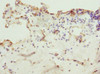 Immunohistochemistry of paraffin-embedded human breast cancer using CSB-PA026830ESR2HU at dilution of 1:100