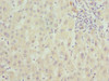 Immunohistochemistry of paraffin-embedded human liver cancer using CSB-PA850394ESR2HU at dilution of 1:100