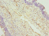 Immunohistochemistry of paraffin-embedded human ovarian cancer using CSB-PA850394ESR2HU at dilution of 1:100