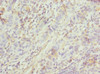 Immunohistochemistry of paraffin-embedded human bladder cancer using CSB-PA757939ESR1HU at dilution of 1:100