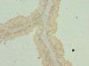 Immunohistochemistry of paraffin-embedded human prostate cancer using CSB-PA623012ESR2HU at dilution of 1:100