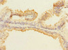 Immunohistochemistry of paraffin-embedded human prostate cancer using CSB-PA013440DSR2HU at dilution of 1:100