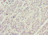 Immunohistochemistry of paraffin-embedded human liver cancer using CSB-PA017928ESR2HU at dilution of 1:100