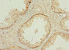 Immunohistochemistry of paraffin-embedded human prostate cancer using CSB-PA856978ESR2HU at dilution of 1:100