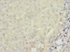 Immunohistochemistry of paraffin-embedded human liver cancer using CSB-PA891960ESR2HU at dilution of 1:100