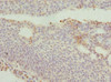 Immunohistochemistry of paraffin-embedded human bladder cancer using CSB-PA866601ESR2HU at dilution of 1:100