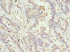 Immunohistochemistry of paraffin-embedded human lung cancer using CSB-PA850410ESR2HU at dilution of 1:100
