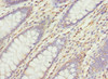 Immunohistochemistry of paraffin-embedded human colon cancer using CSB-PA848385ESR1HU at dilution of 1:100