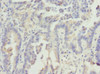 Immunohistochemistry of paraffin-embedded human lung cancer using CSB-PA890750ESR2HU at dilution of 1:100