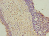 Immunohistochemistry of paraffin-embedded human ovarian cancer using CSB-PA026142ESR2HU at dilution of 1:100