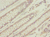 Immunohistochemistry of paraffin-embedded human colon cancer using CSB-PA026145ESR1HU at dilution of 1:100