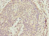 Immunohistochemistry of paraffin-embedded human cervical cancer using CSB-PA863983ESR1HU at dilution of 1:100