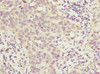 Immunohistochemistry of paraffin-embedded human bladder cancer using CSB-PA010682ESR2HU at dilution of 1:100