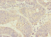 Immunohistochemistry of paraffin-embedded human endometrial cancer using CSB-PA020345ESR2HU at dilution of 1:100