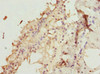 Immunohistochemistry of paraffin-embedded human breast cancer using CSB-PA026606ESR2HU at dilution of 1:100