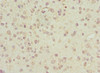 Immunohistochemistry of paraffin-embedded human glioma using CSB-PA887945ESR1HU at dilution of 1:100