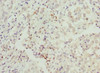 Immunohistochemistry of paraffin-embedded human lung cancer using CSB-PA613484ESR1HU at dilution of 1:100