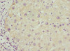 Immunohistochemistry of paraffin-embedded human liver cancer using CSB-PA613484ESR1HU at dilution of 1:100