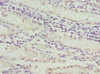 Immunohistochemistry of paraffin-embedded human gastric cancer using CSB-PA003490ESR1HU at dilution of 1:100