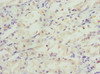 Immunohistochemistry of paraffin-embedded human gastric cancer using CSB-PA003490ESR2HU at dilution of 1:100