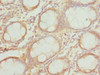 Immunohistochemistry of paraffin-embedded human colon cancer using CSB-PA621520ESR2HU at dilution of 1:100